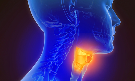 Oral sex throat cancer